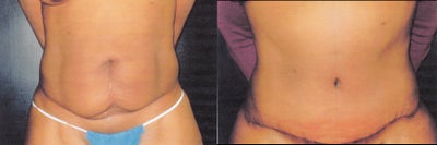 Case 2410 - 28 Year Old - Abdominoplasty