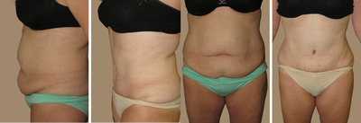 Case 2411 - Abdominoplasty tummy tuck 