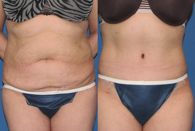 Case 2413 - Tummy Tuck