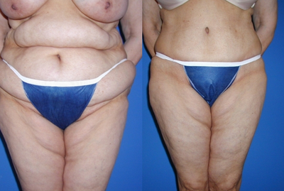 Case 2414 - Tummy Tuck