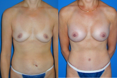 Case 2415 - Tummy Tuck