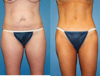 Case 2416 - Tummy Tuck