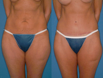 Case 2417 - Tummy Tuck