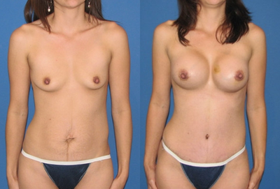 Case 2418 - Tummy Tuck