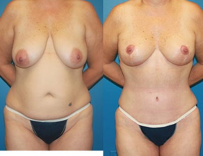 Case 2419 - Tummy Tuck