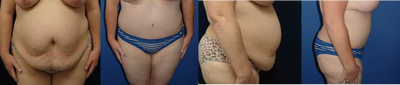 Case 2420 - Mastopexy- augmentation, liposuction and abdominoplasty