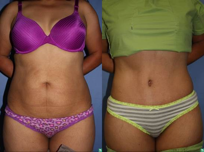 Case 2421 - 39 year old female abdominoplasty and flank liposuction