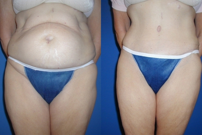 Case 2423 - Tummy Tuck