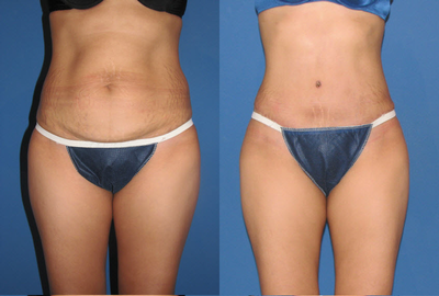 Case 2424 - Tummy Tuck