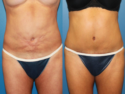 Case 2425 - Tummy Tuck