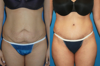 Case 2426 - Tummy Tuck