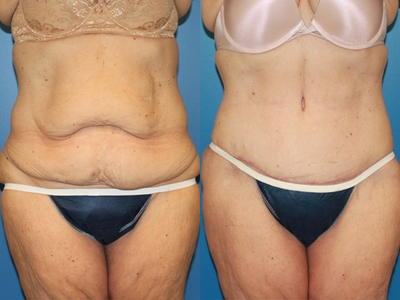 Case 2427 - Tummy Tuck