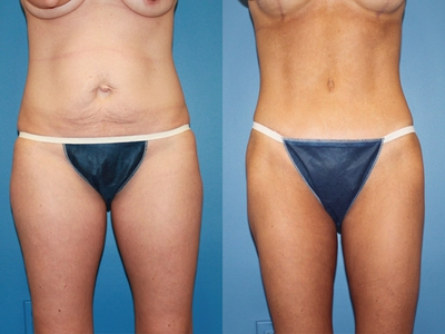 Case 2428 - Tummy Tuck