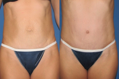 Case 2429 - Tummy Tuck
