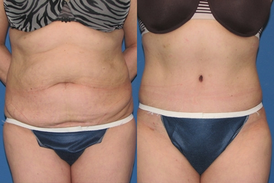 Case 2430 - Tummy Tuck
