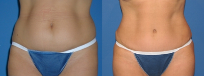 Case 2431 - Tummy Tuck
