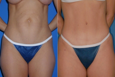 Case 2432 - Tummy Tuck