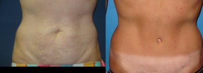 Case 2433 - Tummy Tuck Before & After