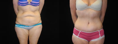 Case 2435 - 35 year old female patient before and after a tummy tuck
