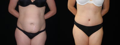 Case 2436 - Tummy Tuck after Abdominal surgery