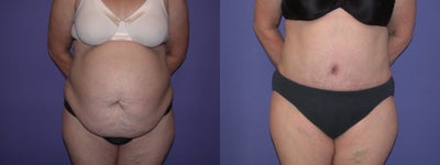 Case 2437 - 55 year old mother Before and After a Full Abdominoplasty (Tummy Tuck)