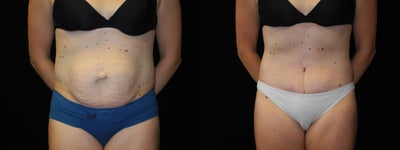 Case 2438 - 40 year old mom before and after abdominoplasty (tummy tuck)