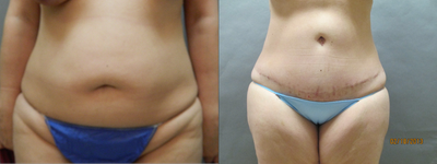 Case 2440 - Abdominoplasty with Liposuction