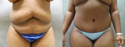 Case 2441 - Abdominoplasty with liposuction to the abdomen and hiprolls
