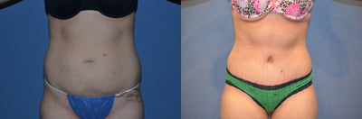 Case 2442 - Female who had abdominoplasty after childbirth