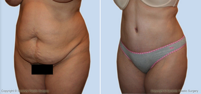 Case 2443 - Tummy Tuck