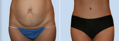 Case 2444 - Tummy Tuck