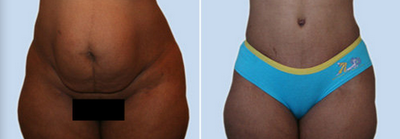 Case 2445 - Tummy Tuck