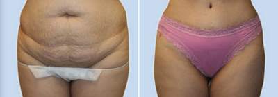 Case 2446 - Tummy Tuck