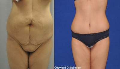 Case 2447 - Tummy Tuck