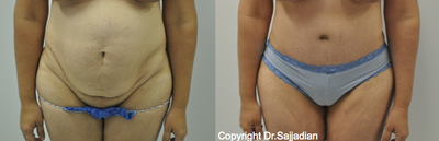 Case 2448 - Tummy Tuck