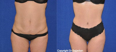 Case 2449 - Tummy Tuck