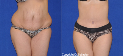 Case 2450 - Tummy Tuck