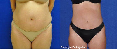 Case 2451 - Tummy Tuck