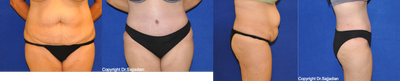 Case 2452 - Tummy Tuck