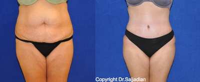 Case 2453 - Tummy Tuck