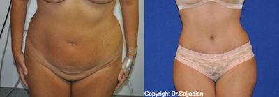 Case 2454 - Tummy Tuck