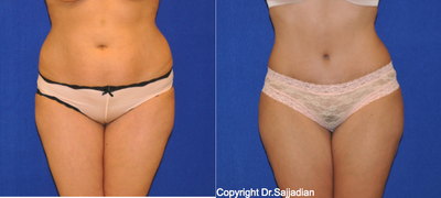Case 2455 - Tummy Tuck