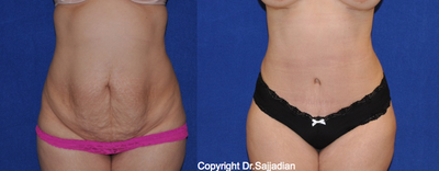 Case 2456 - Tummy Tuck