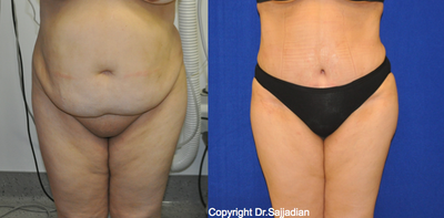 Case 2457 - Tummy Tuck
