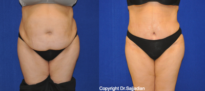 Case 2458 - Tummy Tuck