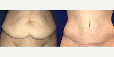 Case 247 - Woman treated with Tummy Tuck