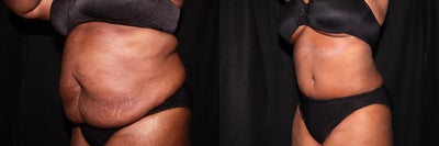 Case 2470 - Tummy Tuck - Abdominoplasty