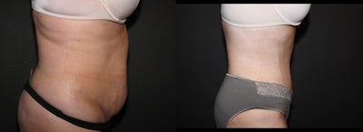 Case 2471 - Tummy Tuck - Abdominoplasty