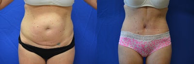 Case 2472 - 41 year old female who underwent a tummy tuck