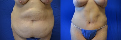 Case 2477 - 38 y/o who underwent tummy tuck and liposuction